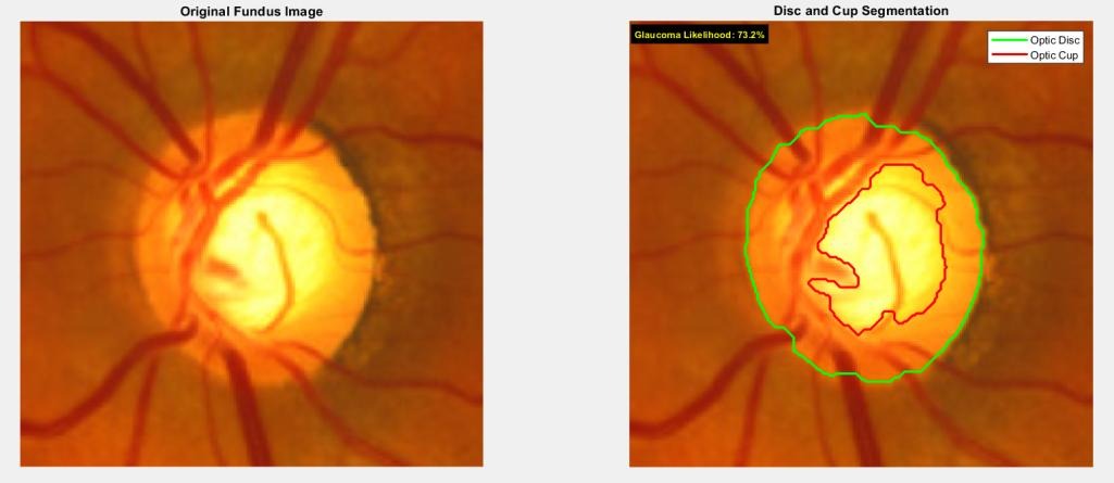 A retinal fundus image next to the same image with the optic disc outlined in green and the cup in red