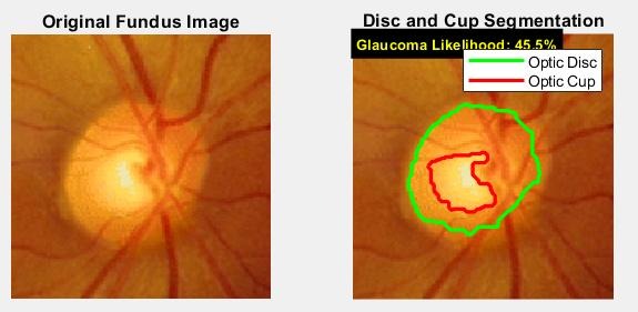Fundus image 3 with disc and cup outlined