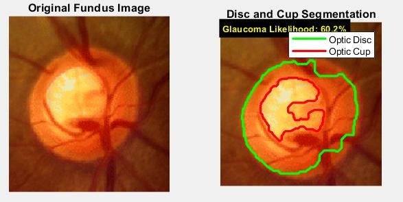 Fundus image 4 with disc and cup outlined