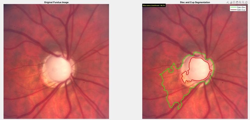 Fundus image 5 where the cup outline spills past the disc